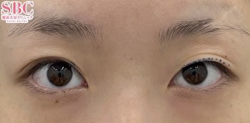 【20代女性・目元】週末二重(R)_before