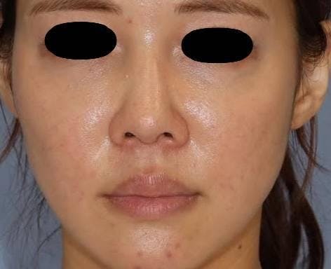 聖心美容クリニック 六本木院で鼻の整形：鼻中延長術・隆鼻術・貴族手術を受けたMAYUさんの写真