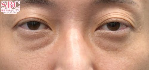 【目元】目の下の切らないクマ・たるみ（ふくらみ）取り、ナチュラル脂肪注射コンデンスリッチ、ナチュラル脂肪注射ナノリッチ_before