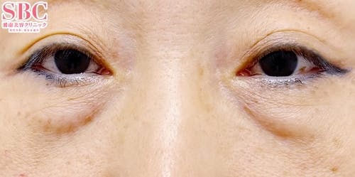 【50代女性・たるみ】目の下の切らないクマ・たるみ（ふくらみ）取り、ナチュラル脂肪注射コンデンスリッチ、ナチュラル脂肪注射ナノリッチ_before