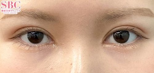 【女性・目元】クイックコスメティーク・ダブルNeo、目頭切開プレミアム、MD式切開法_after