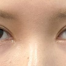 【女性・目元】クイックコスメティーク・ダブルNeo、目頭切開プレミアム、MD式切開法_after