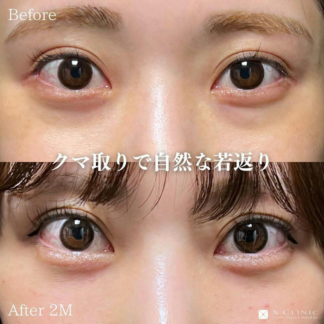 【20代女性・目元】クマ取りフルコース(クマ取り＋コンデンス＋ナノファット)_before_aftar