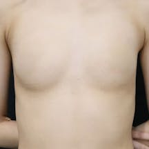 【20代前半女性・胸】Motivaエルゴノミックス2(バッグ豊胸)、エクスパレル_before