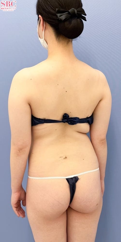 【女性・上半身】根こそぎVASER脂肪吸引、Aquicell（アキーセル）脂肪吸引_before