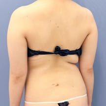 【女性・上半身】根こそぎVASER脂肪吸引、Aquicell(アキーセル)脂肪吸引_before