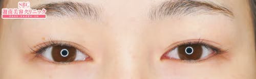 【女性・目元】クイックコスメティーク・ダブルNeo_before