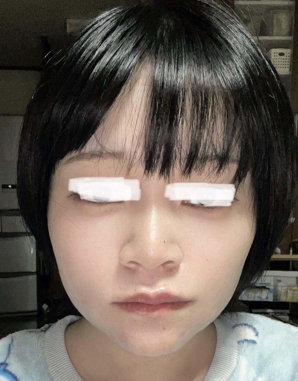 ルラ美容クリニック 渋谷本院でインモードリフティングを受けたゆかさんの写真