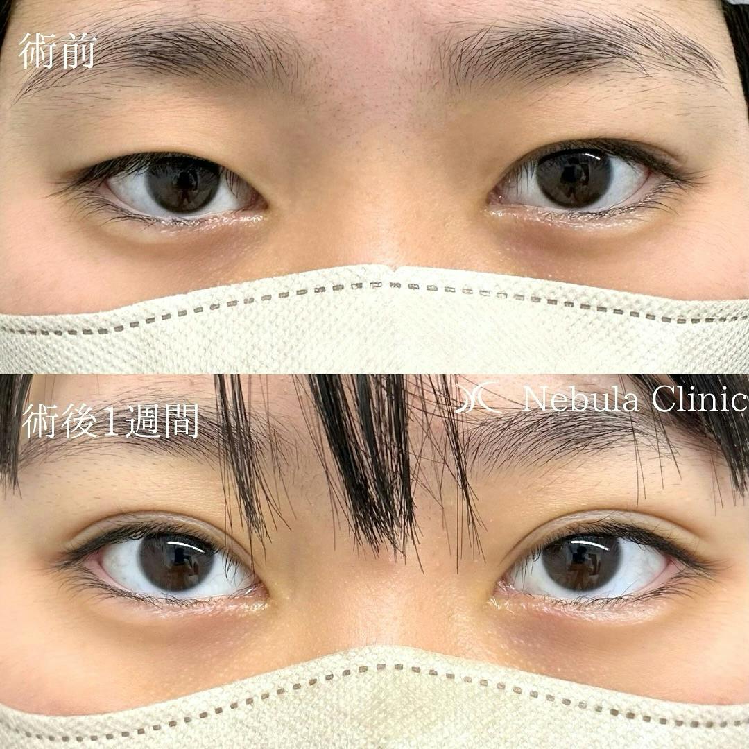 【女性・目元】二重埋没法_before_aftar