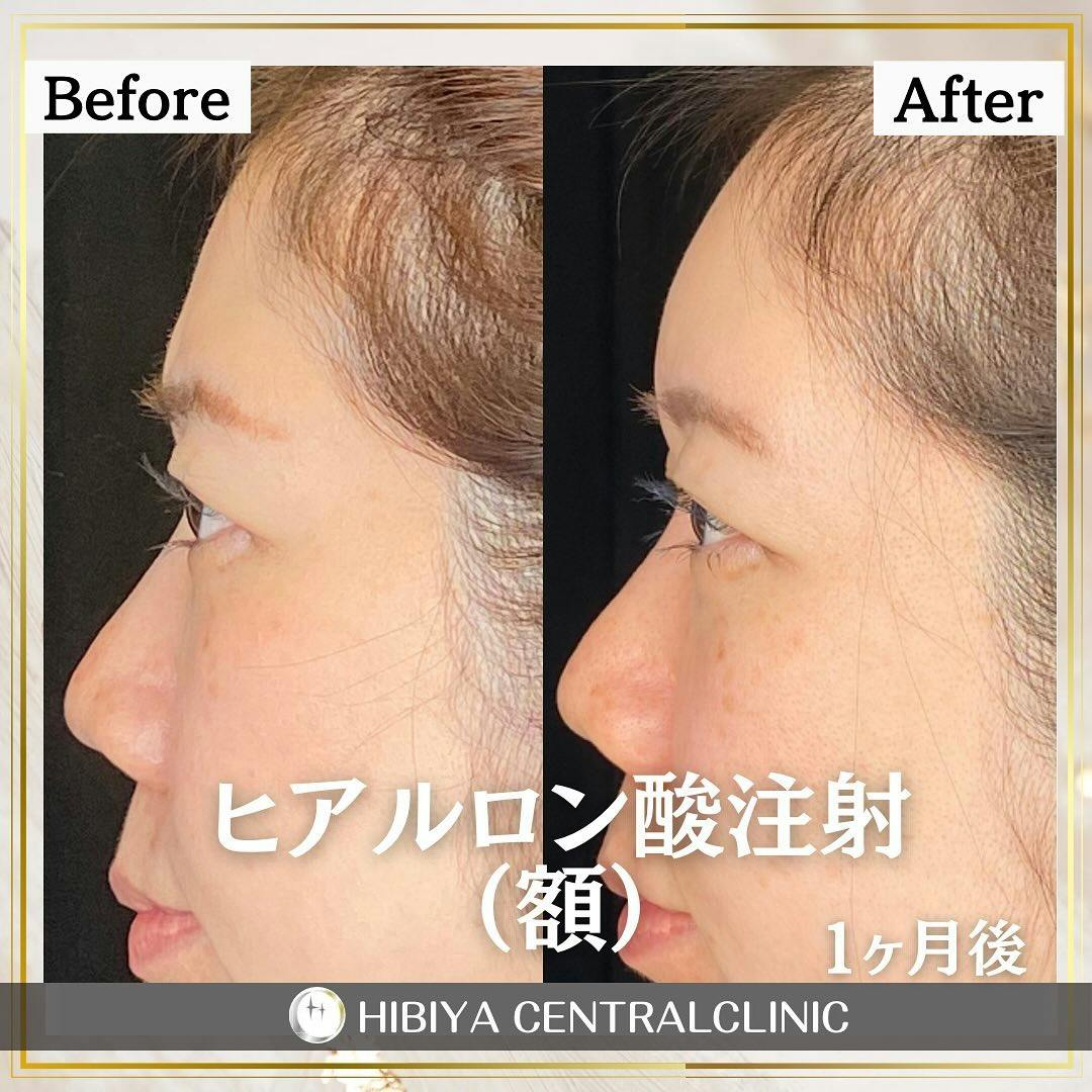 【女性・額】ヒアルロン酸注射_before_aftar