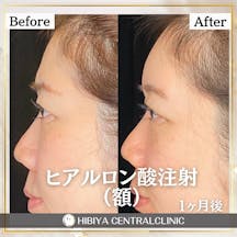 【女性・額】ヒアルロン酸注射_before_aftar