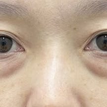 【女性・クマ】目の下の切らないクマ・たるみ(ふくらみ)取り、ナチュラル脂肪注射コンデンスリッチ_before