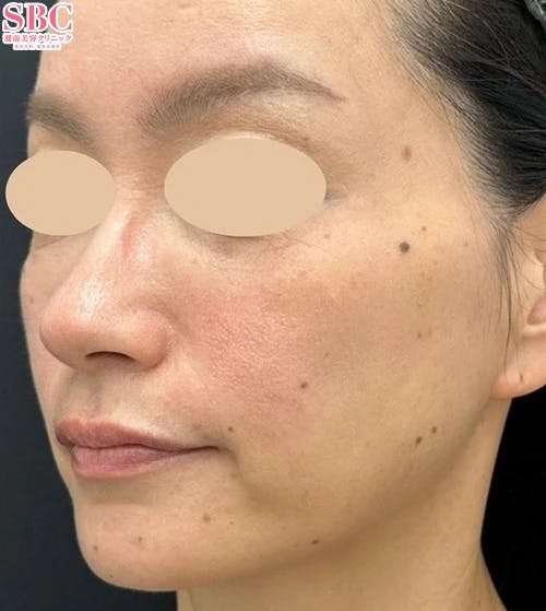 【50代女性・輪郭】ヒアルロン酸・SBCトキシルスレッド~女優注射(R)成分配合~_after
