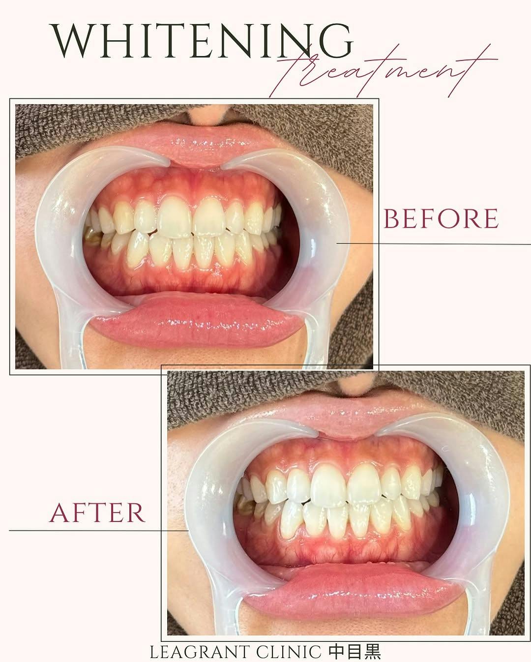 【20代女性・歯】ポリリンホワイトニング_before_aftar