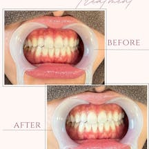 【20代女性・歯】ポリリンホワイトニング_before_aftar