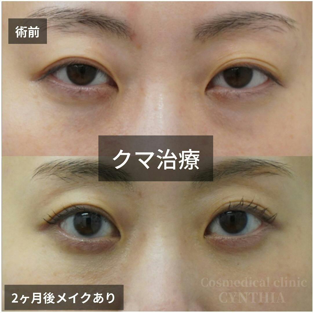 【女性・目元】目の下のクマ・たるみ取り_before_aftar