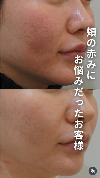 【女性・赤み】エルメス注射×エルメスピール_before_aftar