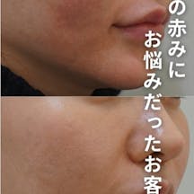 【女性・赤み】エルメス注射×エルメスピール_before_aftar