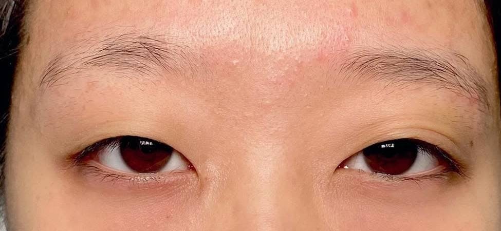 湘南美容クリニック 横浜院で二重埋没法：自然癒着法を受けたみなもさんの写真