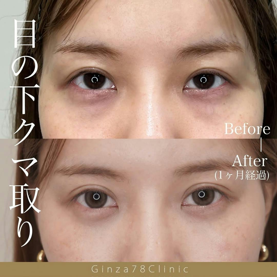 【女性・目元】目の下のクマ取り_before_aftar