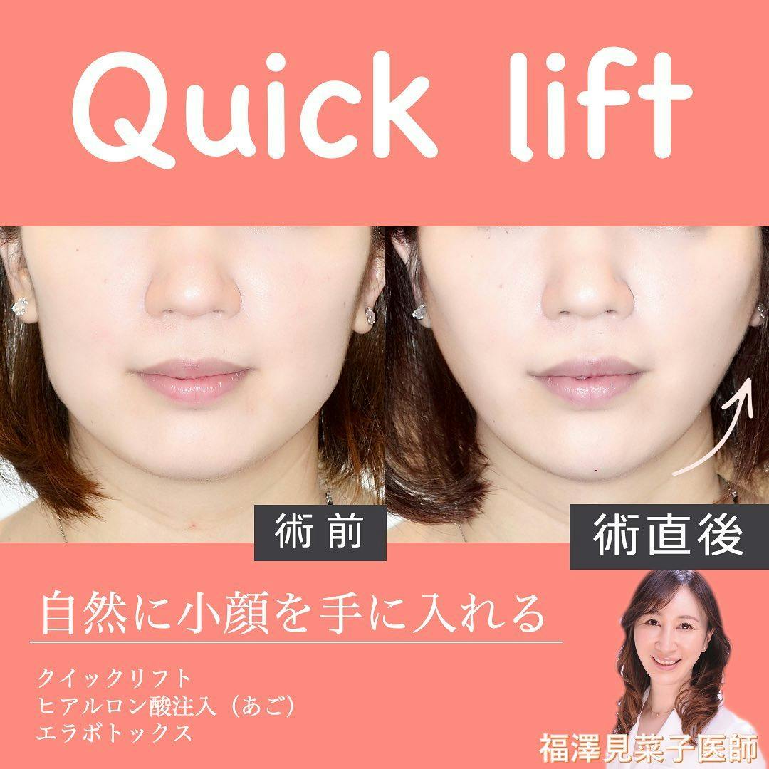 【女性・小顔】クイックリフト、エラボトックス、ヒアルロン酸（顎）_before_aftar