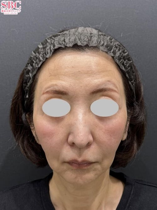 【60代女性・輪郭】スマスフェイスリフト_before