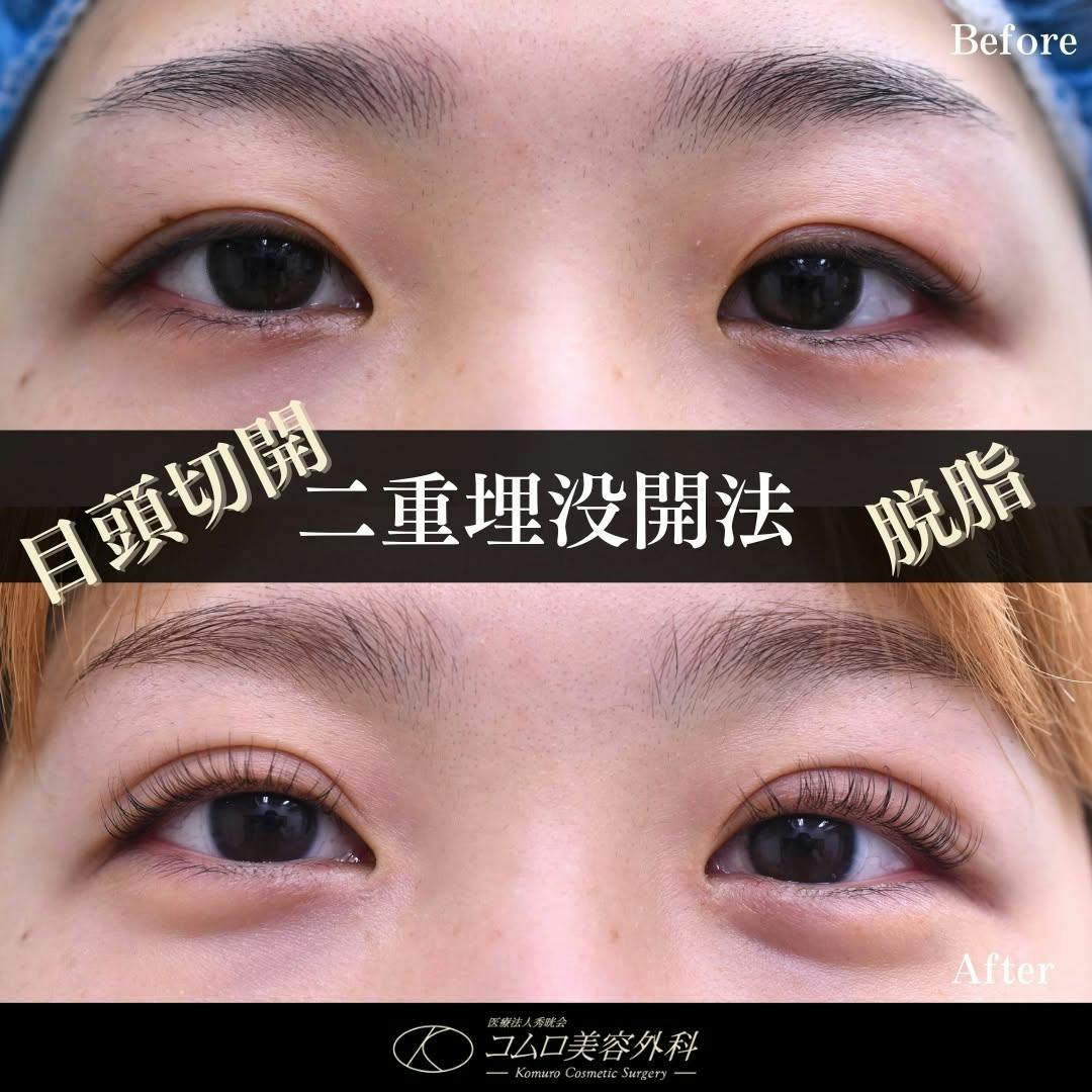 【30代女性・目元】埋没法・脱脂・目頭切開_before_aftar