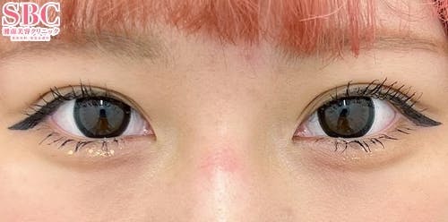 【20代女性・目元】クイックコスメティーク・ダブルNeo_after