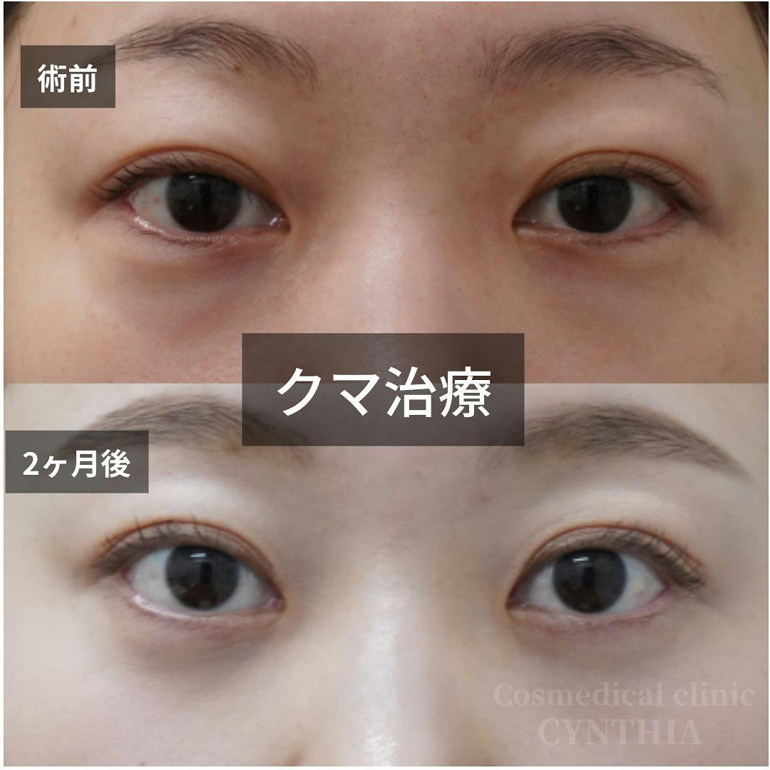 【30代女性・目元】目の下のクマ・たるみ取り_before_aftar