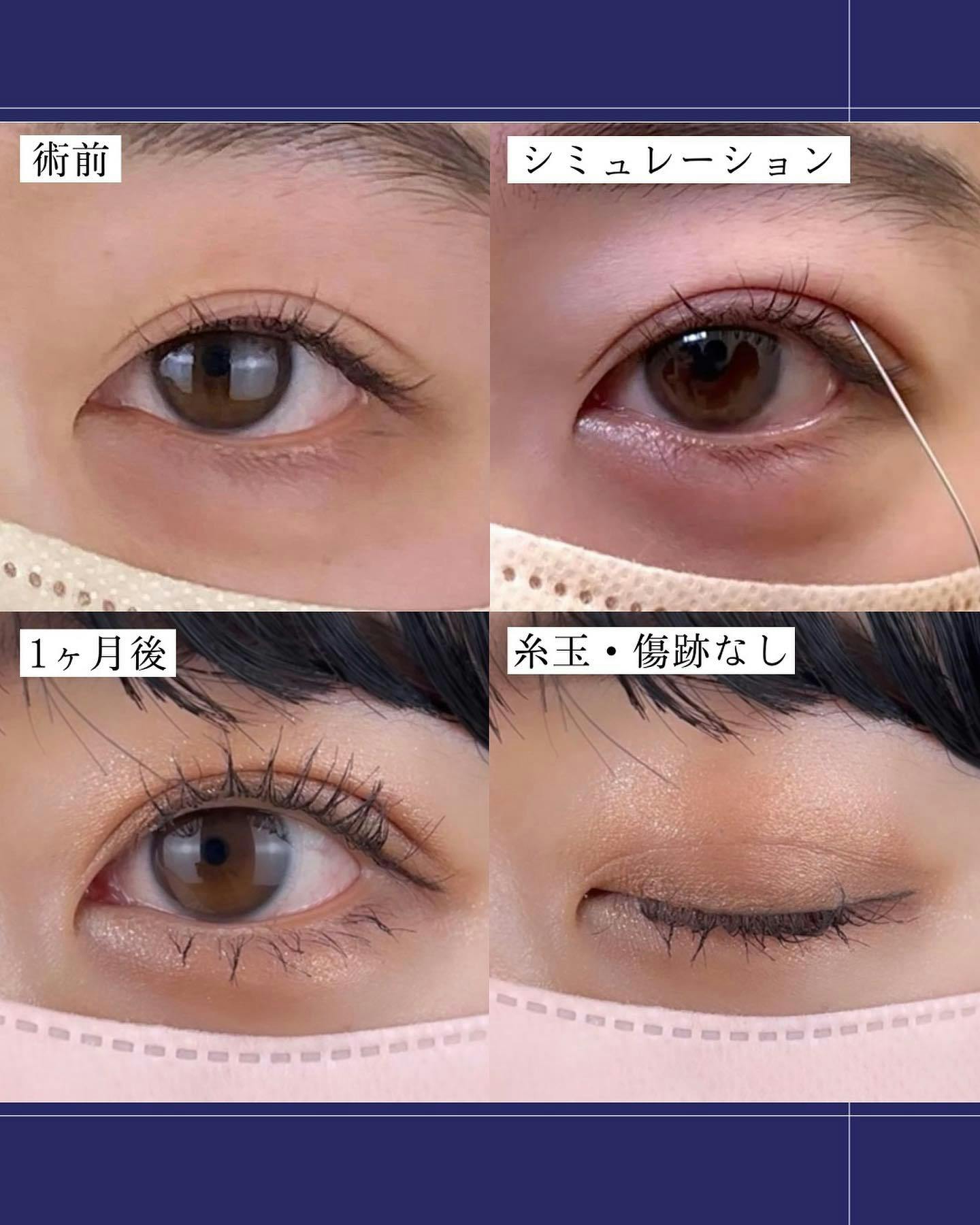 【女性・目元】二重埋没法_before_aftar