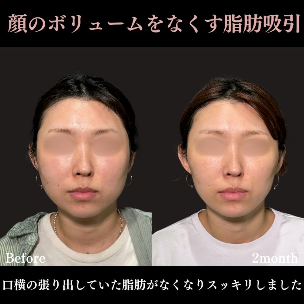 【30代女性・頬・顎下】脂肪吸引クイック（頬・顎下）_before_aftar
