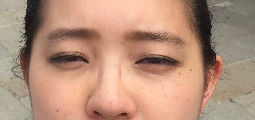 コスメディカルクリニック シンシア 渋谷院で目の下のクマ・たるみ取り・経結膜脱脂法・目元整形を受けたゆっきーさんの写真