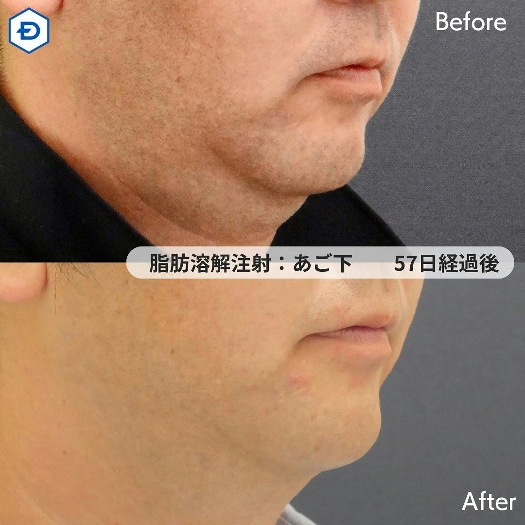 【男性・顎下】脂肪溶解注射（あご下）_before_aftar