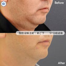 【男性・顎下】脂肪溶解注射(あご下)_before_aftar