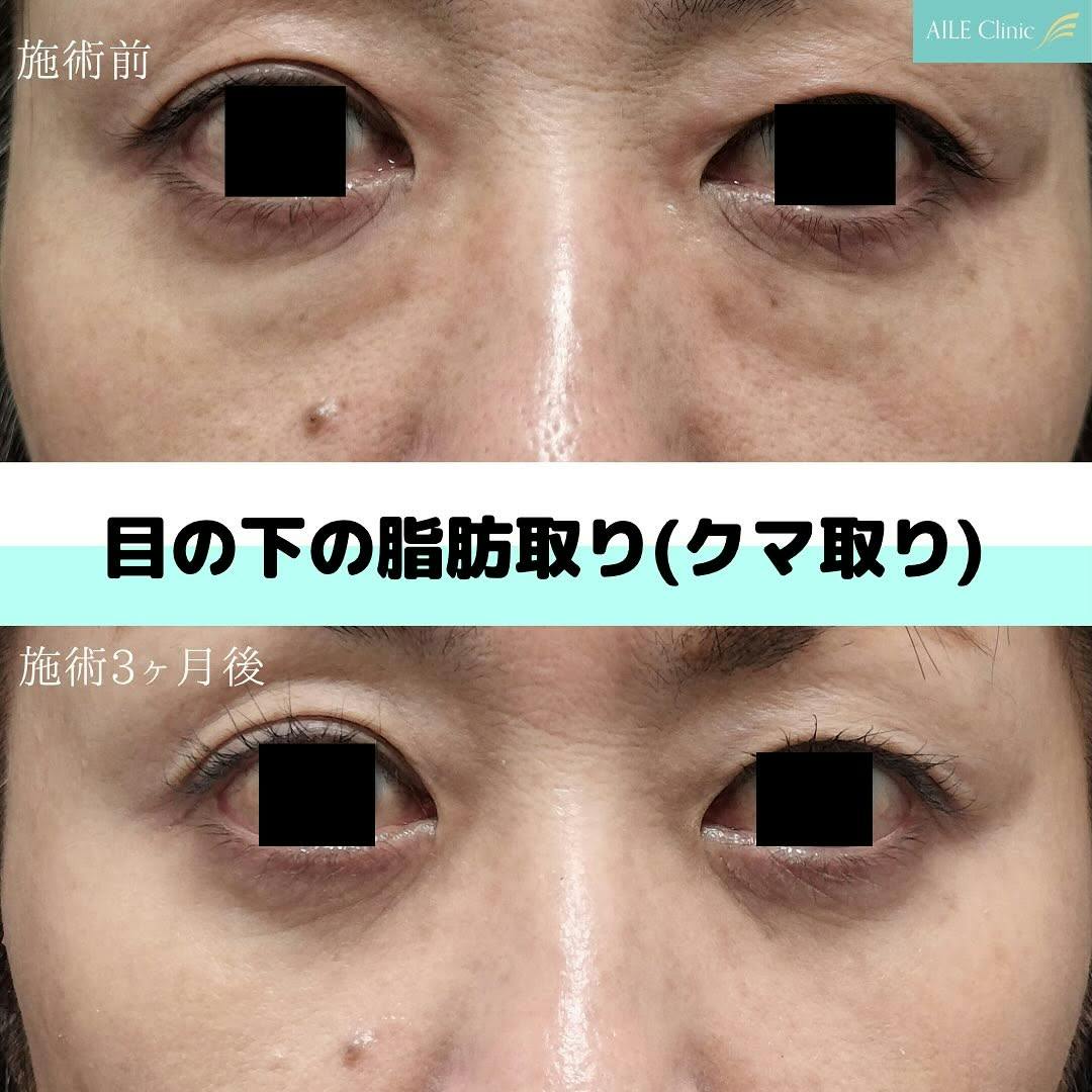 【女性・クマ】目の下の脂肪取り(切らないクマ取り)_before_aftar