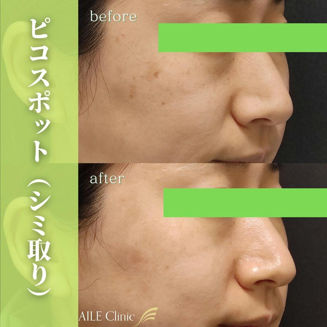【女性・シミ】ピコスポット_before_aftar