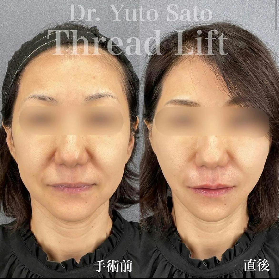 【50代女性・たるみ】糸リフト ヒアルロン酸_before_aftar