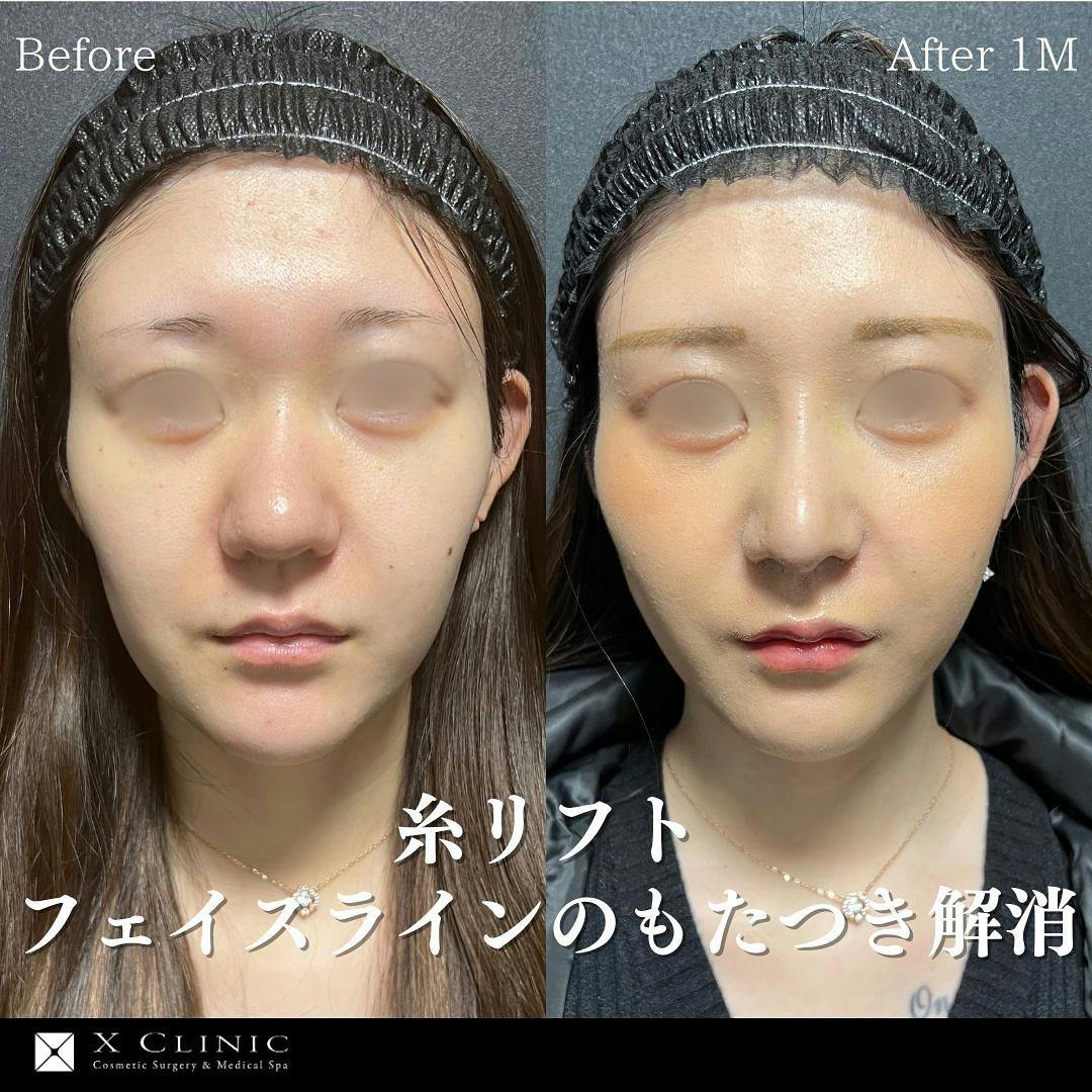 【20代女性・輪郭】糸リフト_before_aftar