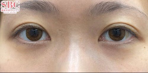 【20代女性・目元】目の下の切らないクマ・たるみ（ふくらみ）取り、ナチュラル脂肪注射コンデンスリッチ、ナチュラル脂肪注射ナノリッチ_after