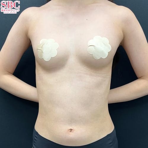 【女性・胸】Aquicell（アキーセル）併用コンデンスリッチ(脂肪注入豊胸)_before