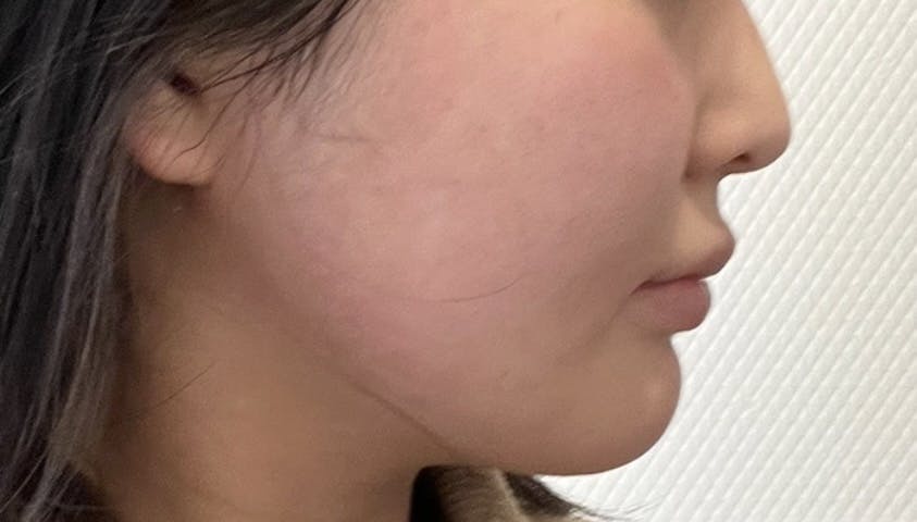 東京秘密クリニック 渋谷院でインモードvリフティングを受けたののさんの写真