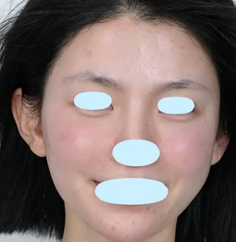 アーモンドクリニック(ALMOND CLINIC)で切らない目の下のクマ・たるみ取り：切らない目の下のクマ・たるみ取りを受けたsakiさんの写真