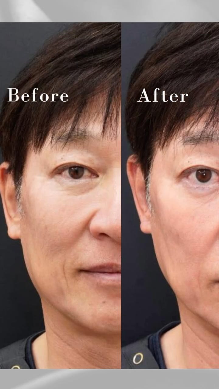 【男性・輪郭】デンシティ_before_aftar