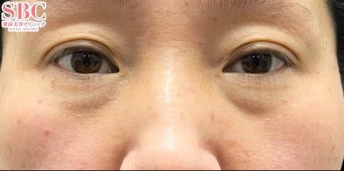 【40代女性・目元】裏ハムラ法_before