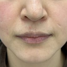 【40代女性・たるみ】VOV(ボブ)リフト・シークレットリフト_before