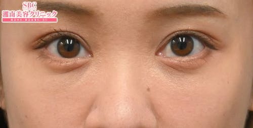 【30代女性・目元】目の下の切らないクマ・たるみ（ふくらみ）取り ナチュラル脂肪注射コンデンスリッチ ナチュラル脂肪注射ナノリッチ_after