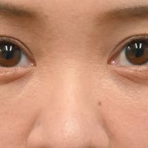 【30代女性・目元】目の下の切らないクマ・たるみ(ふくらみ)取り ナチュラル脂肪注射コンデンスリッチ ナチュラル脂肪注射ナノリッチ_after