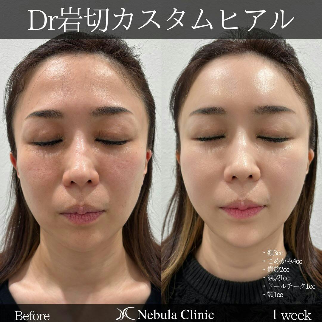 【女性・額・こめかみ・小鼻・涙袋・頬・顎】ヒアルロン酸注入(額・こめかみ・貴族・涙袋・ドールチーク・顎)_before_aftar