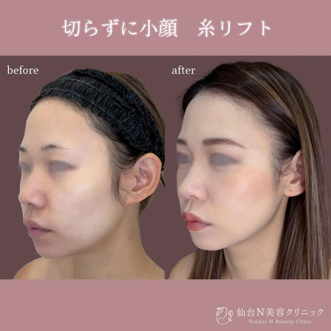 【女性・小顔】糸リフト_before_aftar