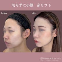 【女性・小顔】糸リフト_before_aftar